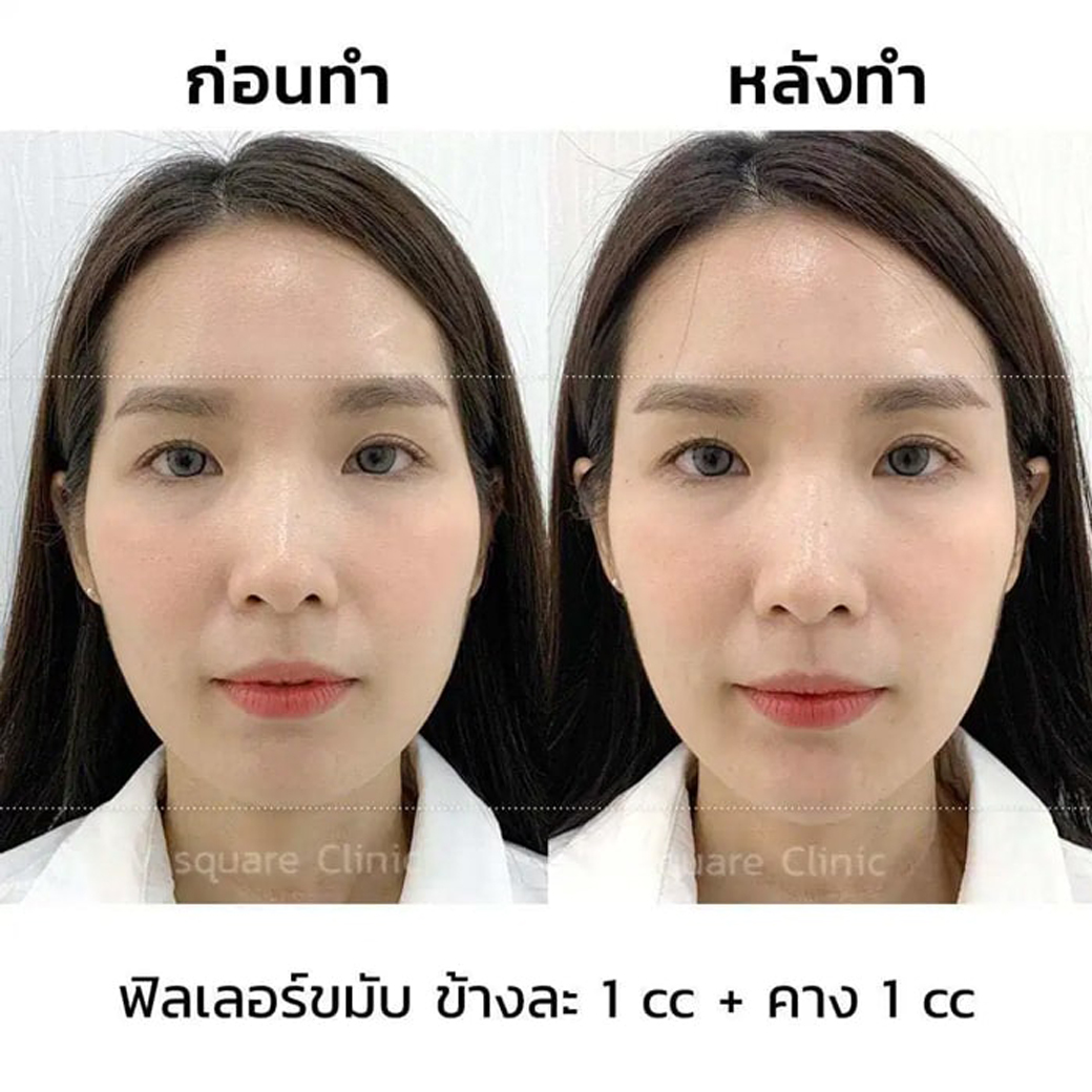รีวิวฉีดฟิลเลอร์ขมับ