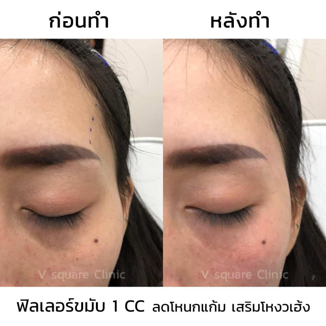 รีวิวฉีดฟิลเลอร์ขมับ
