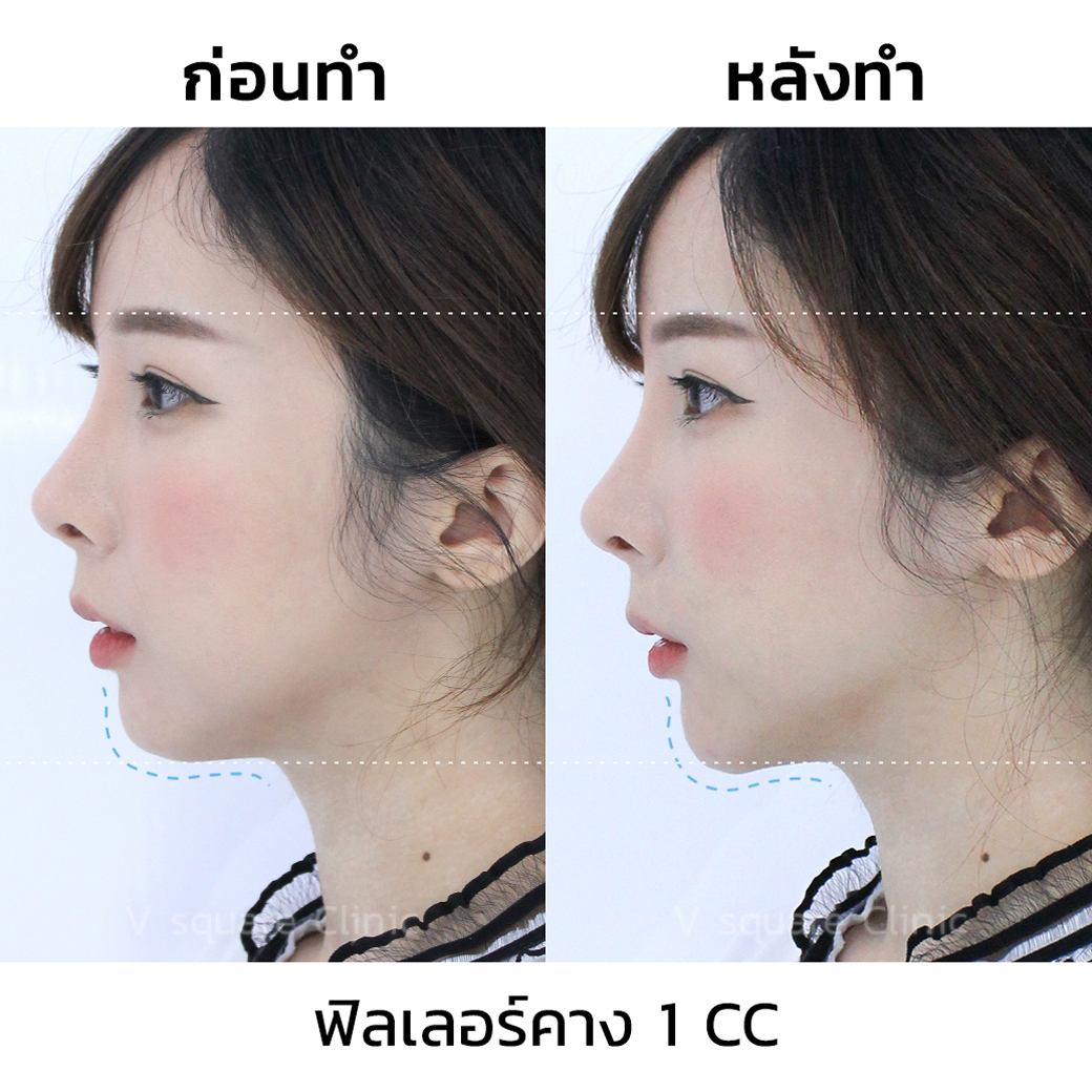 รีวิวฟิลเลอร์คาง