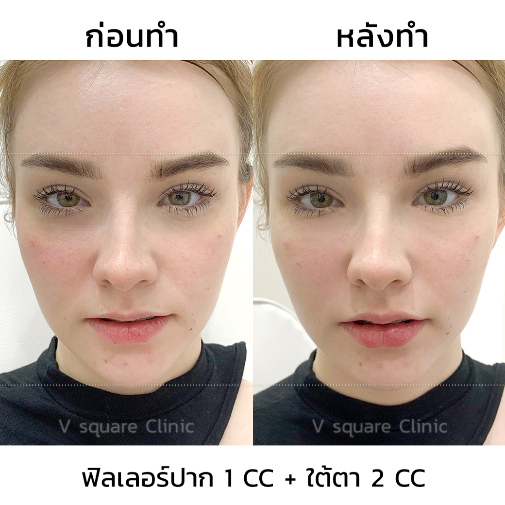 รีวิวฉีดฟิลเลอร์ปาก