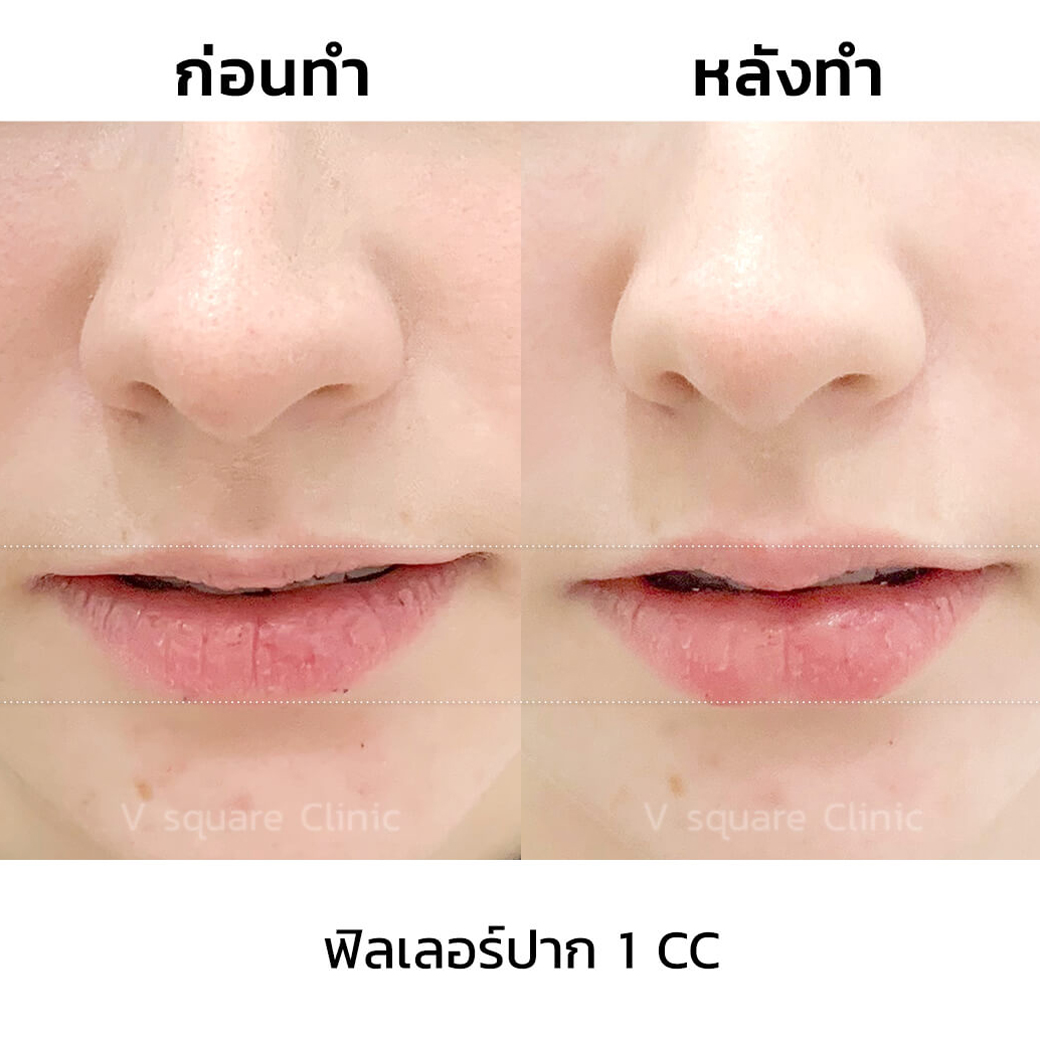 รีวิวฉีดฟิลเลอร์ปาก