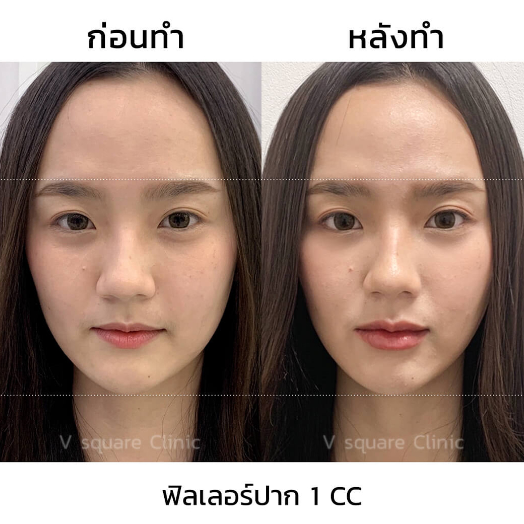 รีวิวฉีดฟิลเลอร์ปาก