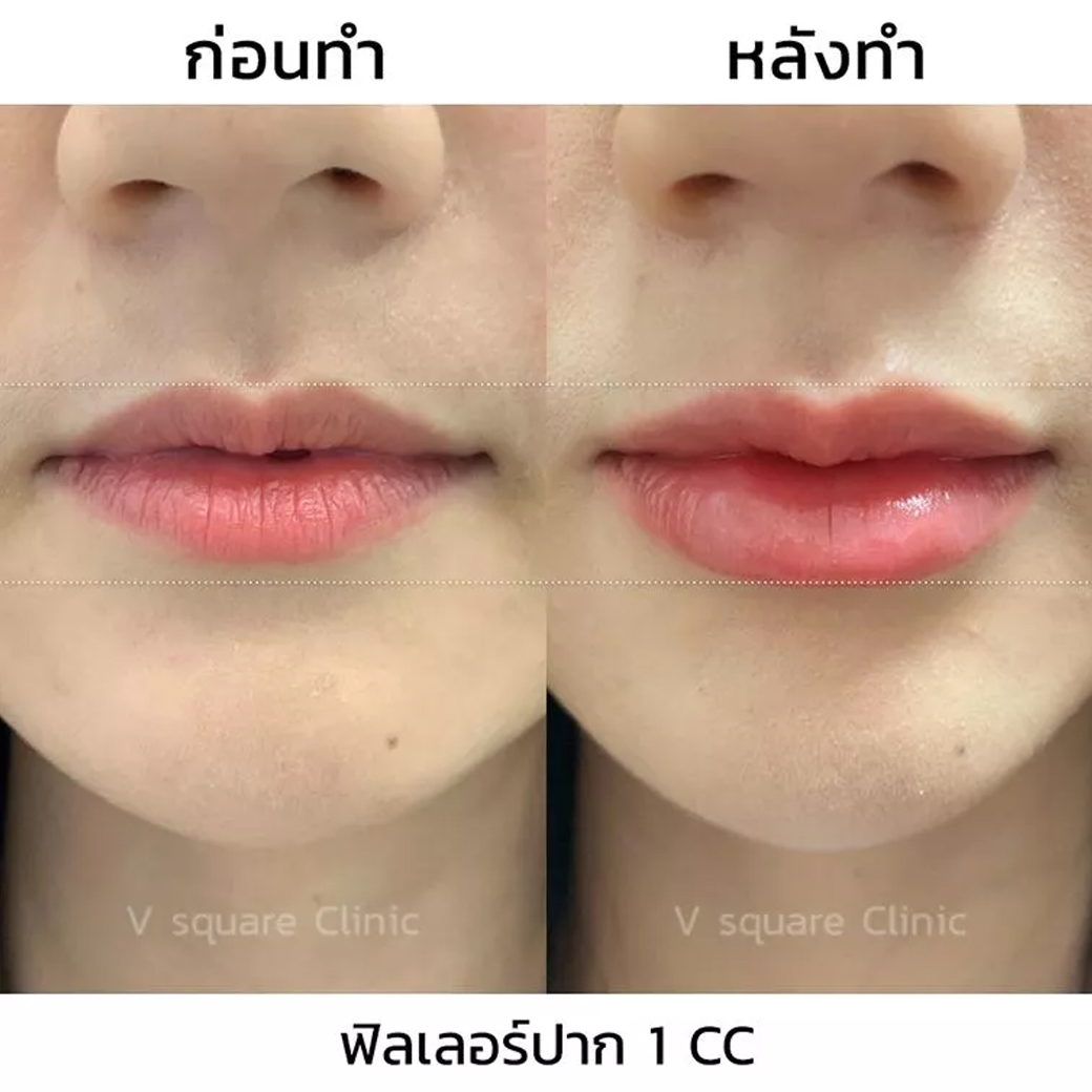 รีวิวฉีดฟิลเลอร์ปาก