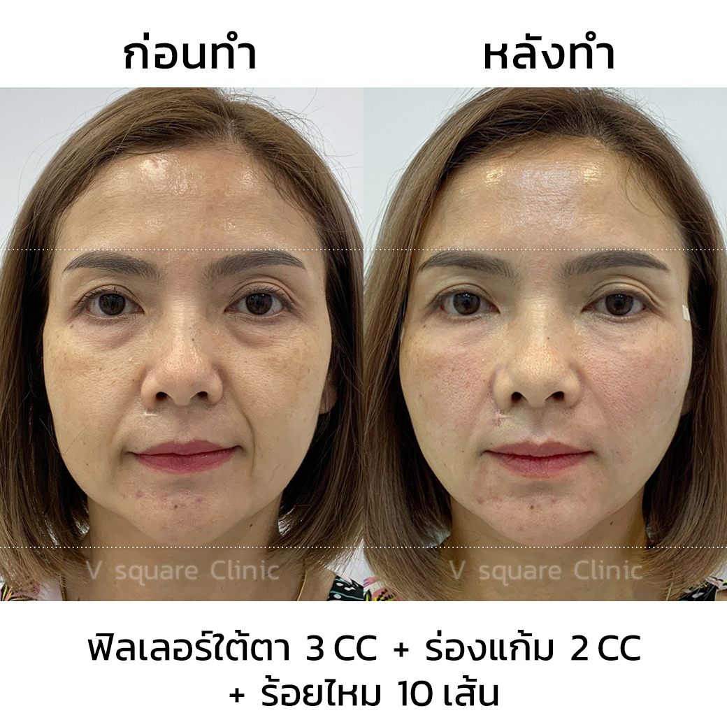 รีวิวฉีดฟิลเลอร์ร่องแก้ม