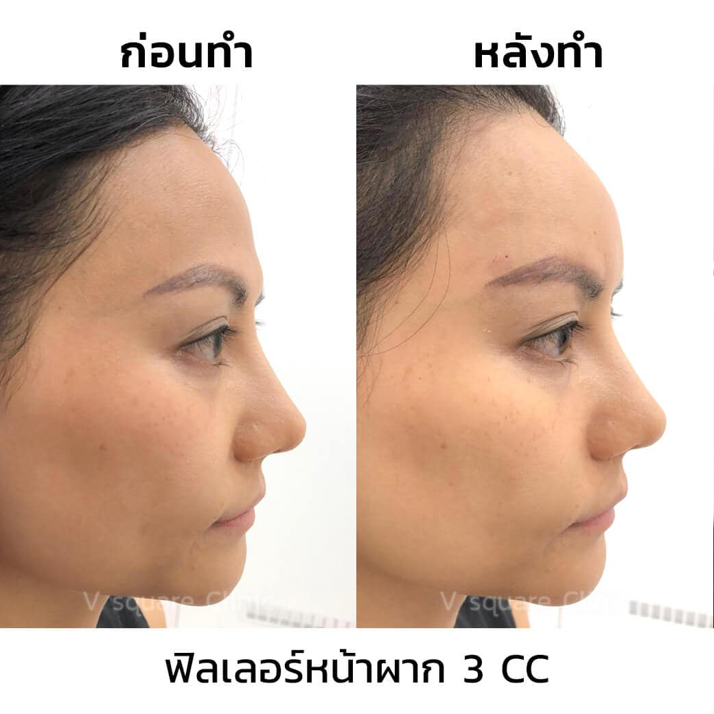 รีวิวฉีดฟิลเลอร์หน้าผาก