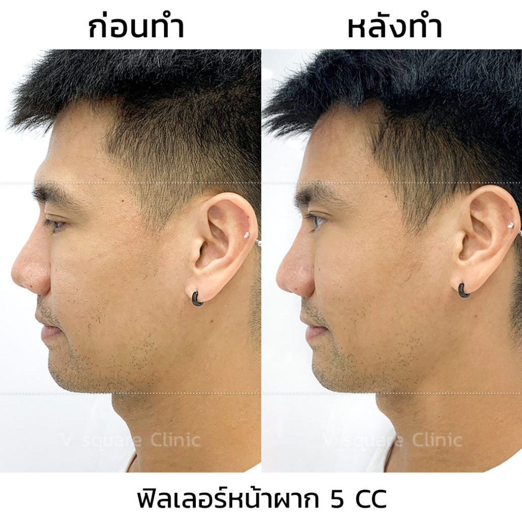 รีวิวฉีดฟิลเลอร์หน้าผากรีวิวฉีดฟิลเลอร์หน้าผาก
