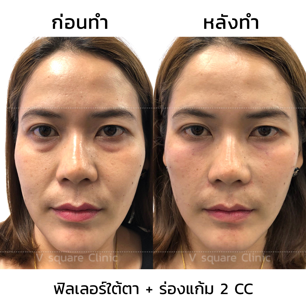 รีวิวฉีดฟิลเลอร์ใต้ตาและร่องแก้ม