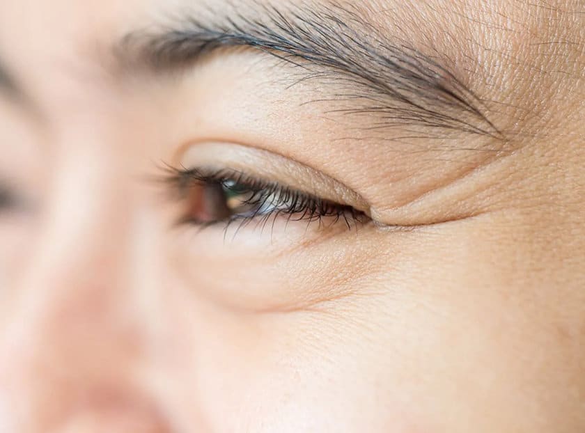 ผิวขาด Hyaluronic Acid