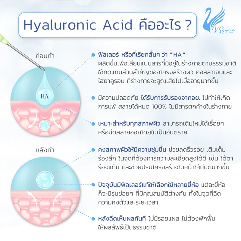 ฟิลเลอร์ Hyaluronic Acid