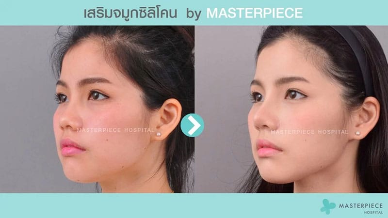 รีวิวเสริมจมูก 1