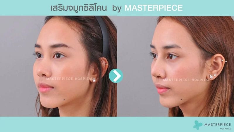 รีวิวเสริมจมูก 2