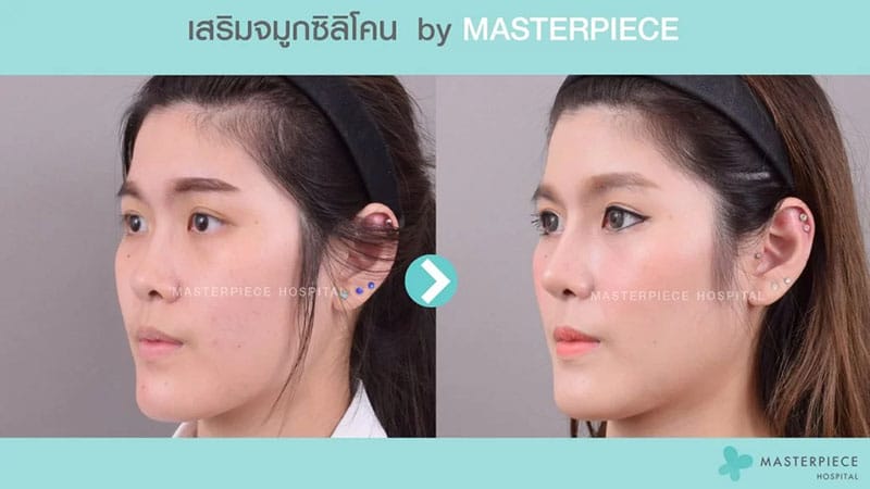 รีวิวเสริมจมูก 3