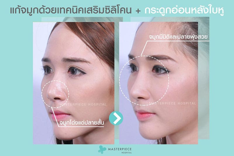 รีวิวเสริมจมูก 4