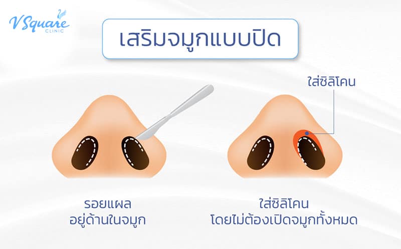 เสริมจมูกแบบปิด