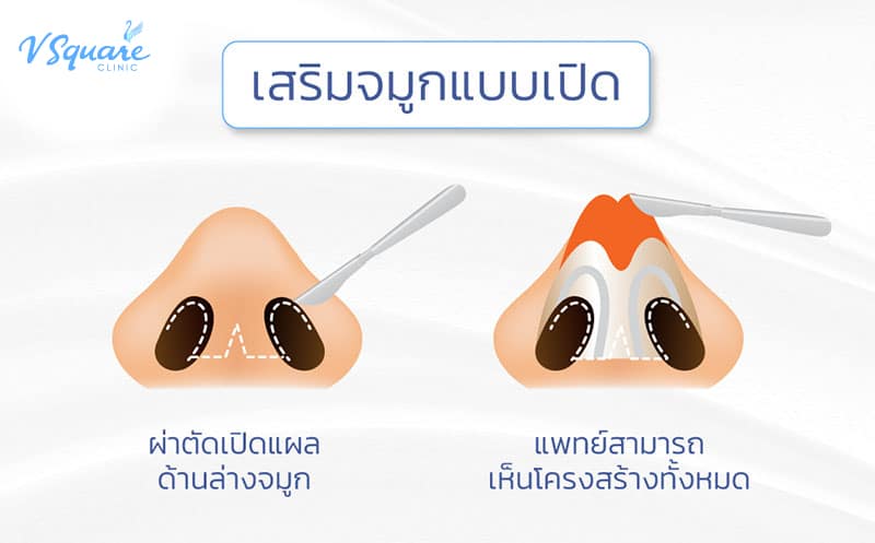เสริมจมูกแบบโอเพ่น