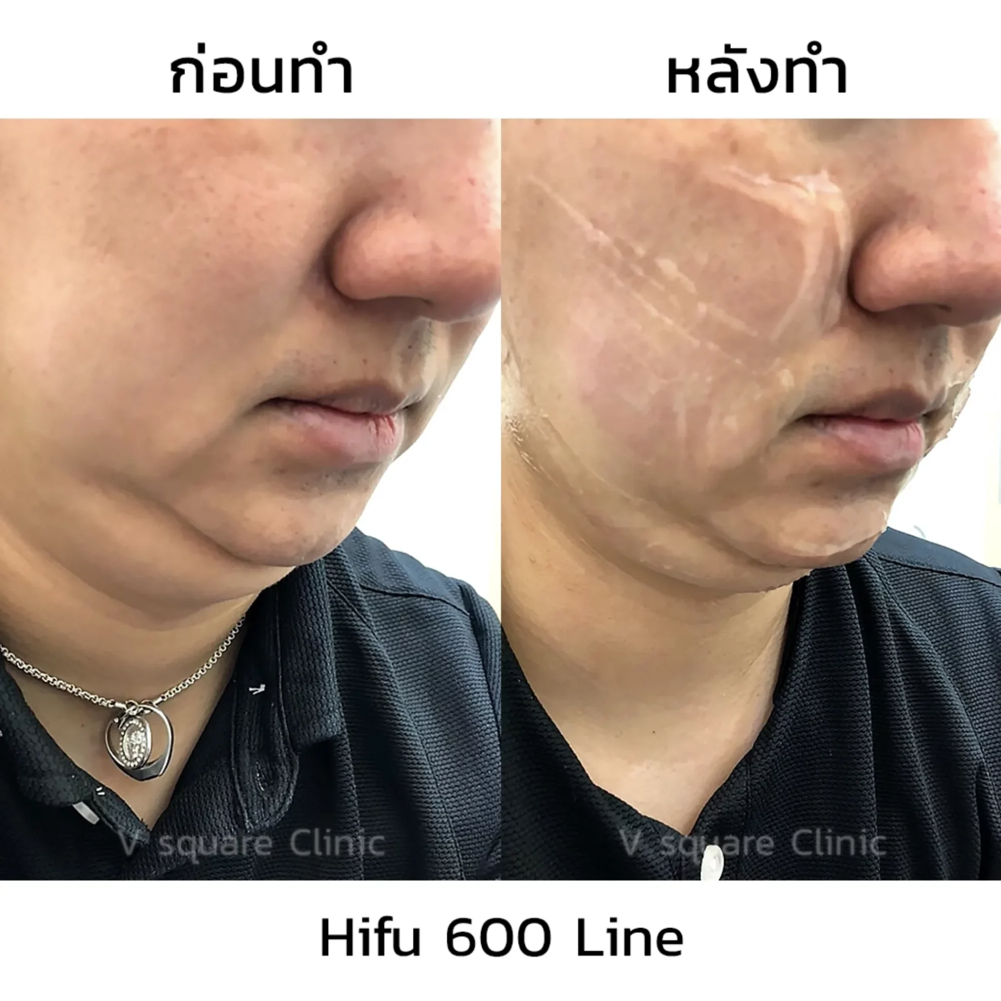 หลังทำ Hifu หน้าบวมกี่วัน? มีข้อห้ามอะไรบ้างที่ควรรู้