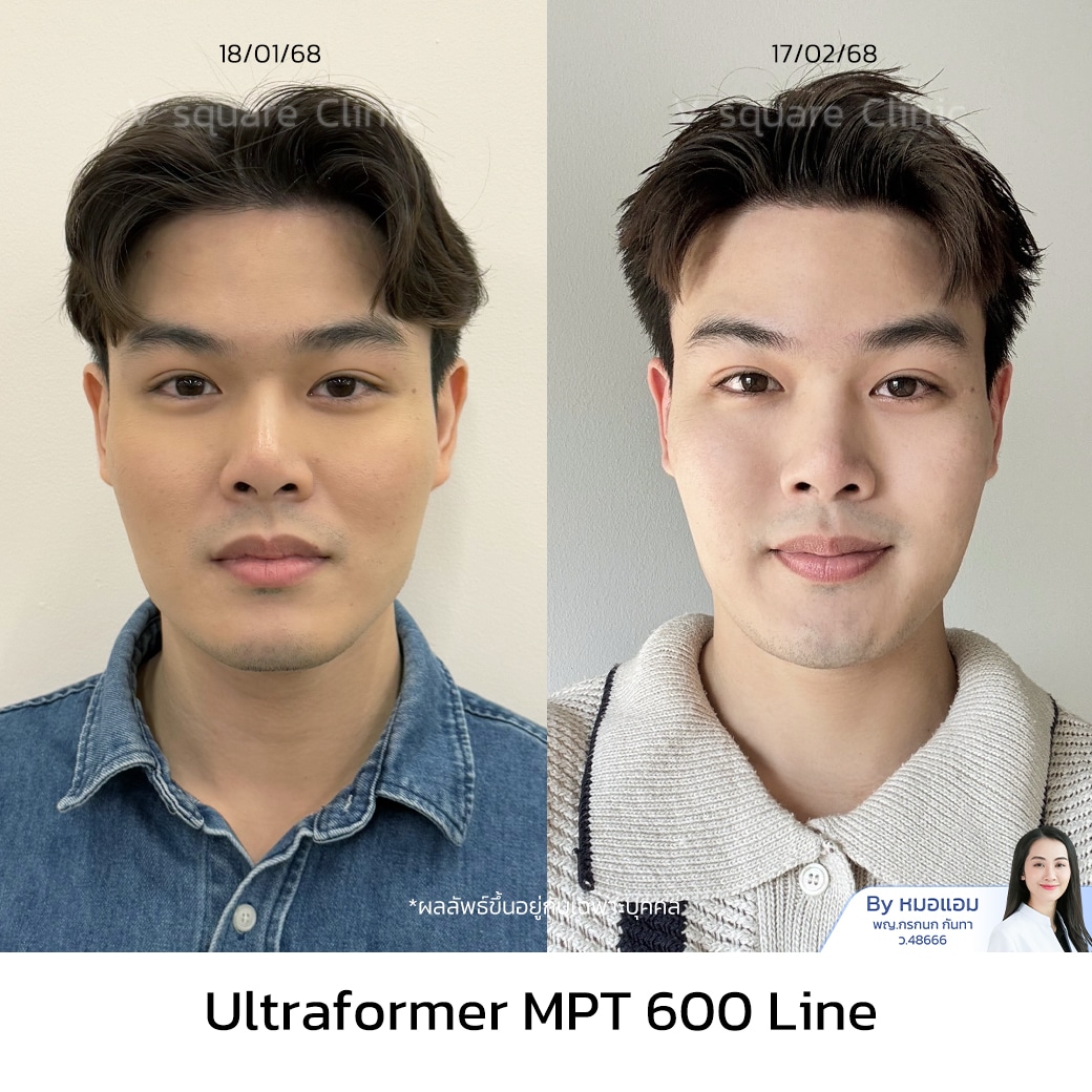Hifu รีวิว_ทอย