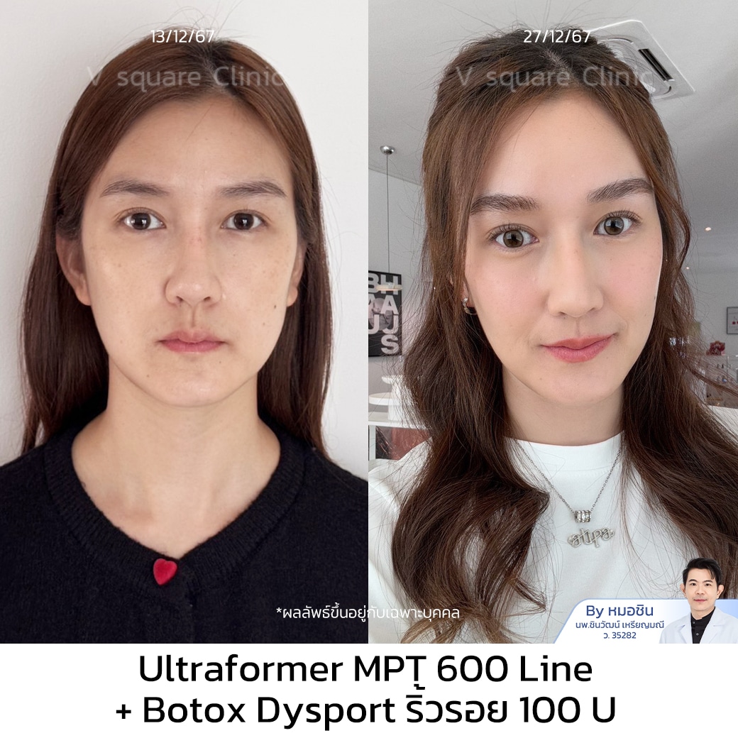 รีวิว Hifu_จูน