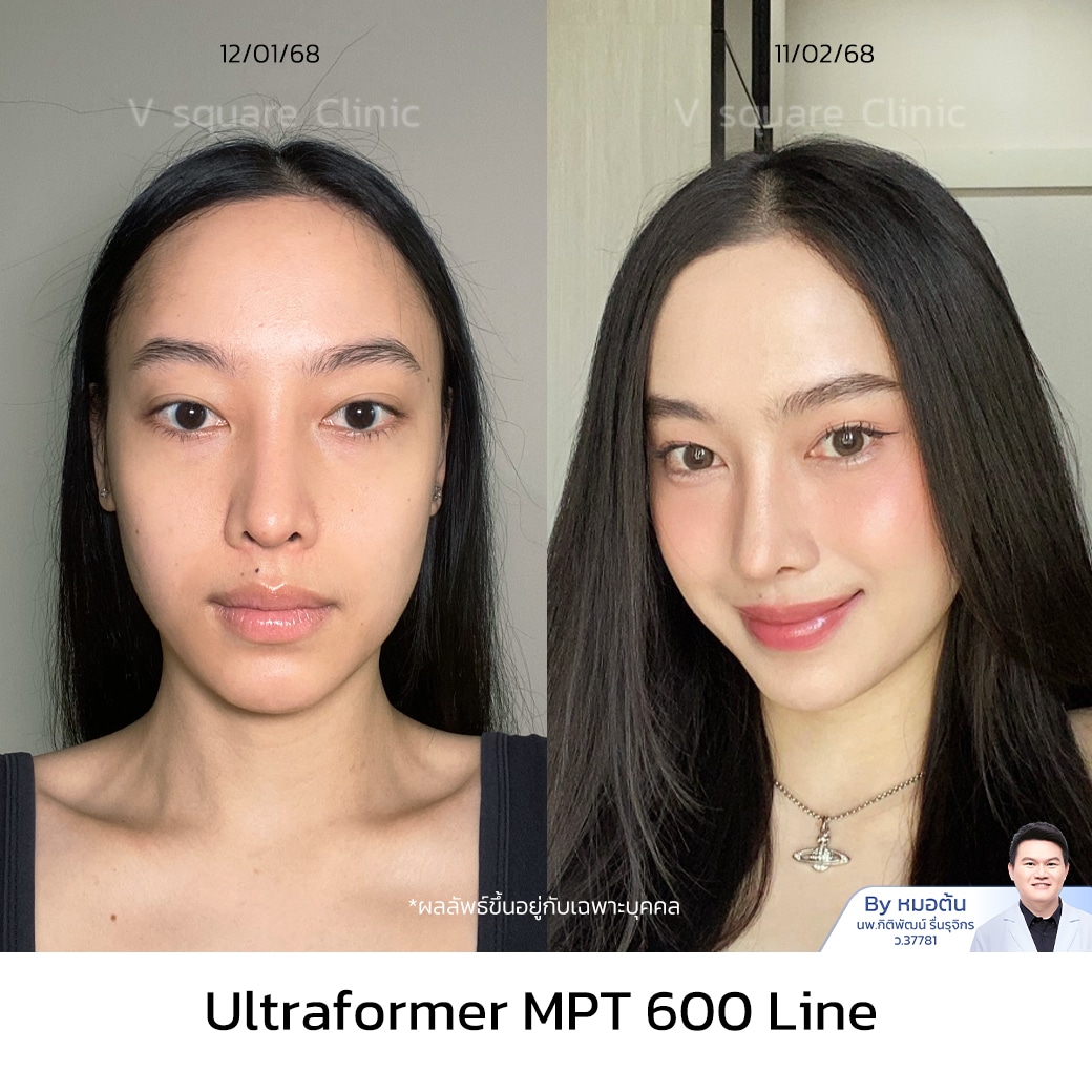 รีวิว Hifu_เกมส์