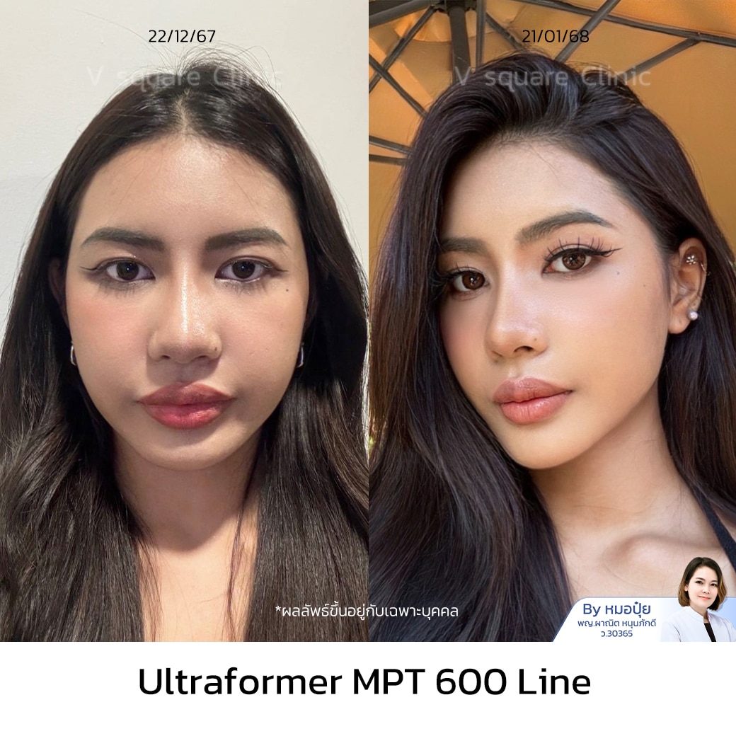 รีวิว ทำ hifu_บินนี่