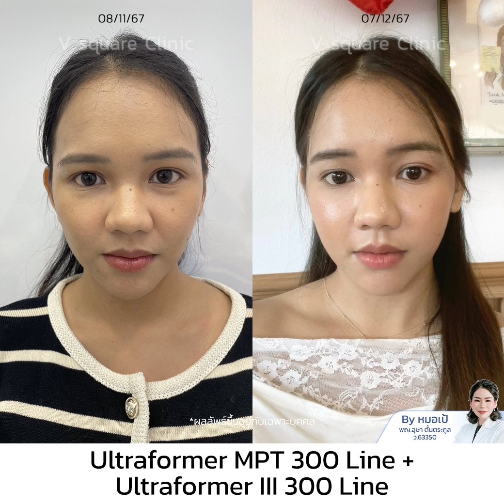 รีวิว หลังทำ Hifu_มายด์_(นักกายทำ)