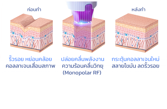 thermage ปล่อยพลังงาน