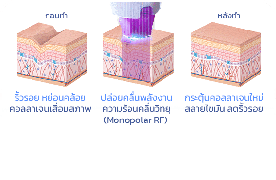 กระบวนการทำงานของ Thermage FLX