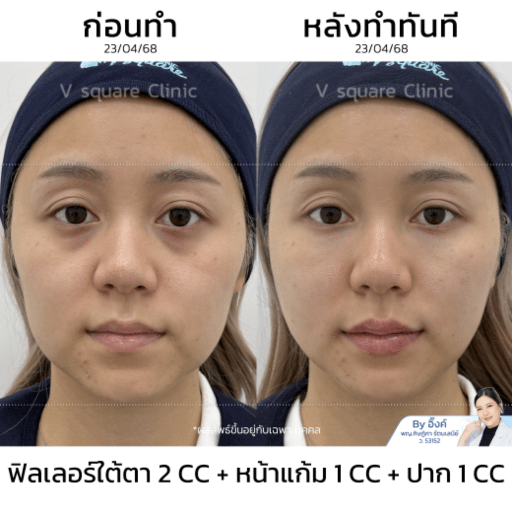 รีวิวฟิลเลอร์ใต้ตา_คุณดอลลาร์