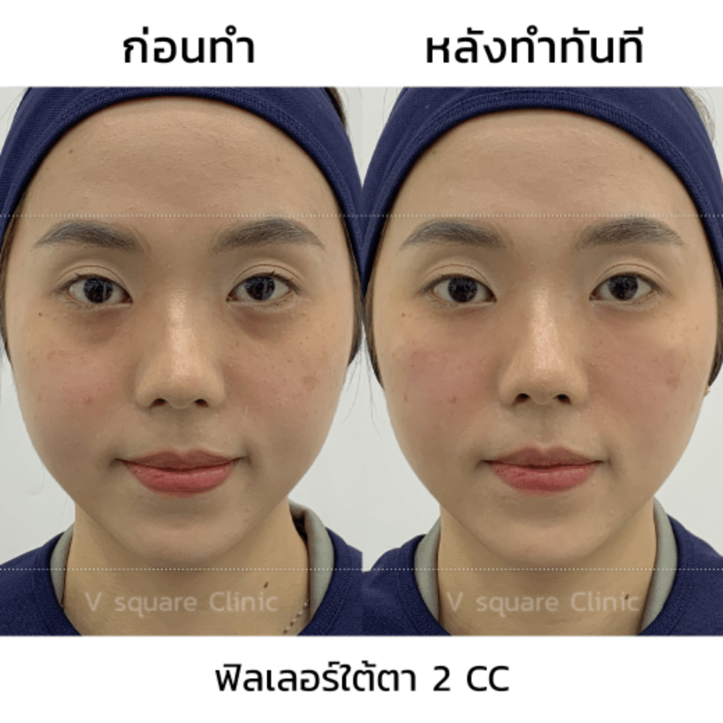 รีวิวฟิลเลอร์ใต้ตา_คุณมิ้น