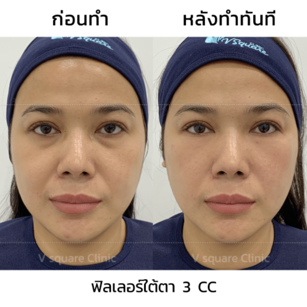 รีวิวฟิลเลอร์ใต้ตา_คุณเปรม