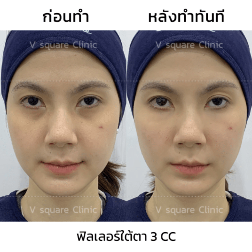รีวิวฟิลเลอร์ใต้ตา_คุณใบหม่อน