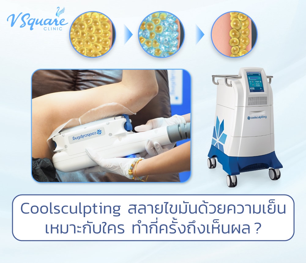 CoolSculpting