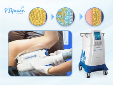 CoolSculpting 370x277
