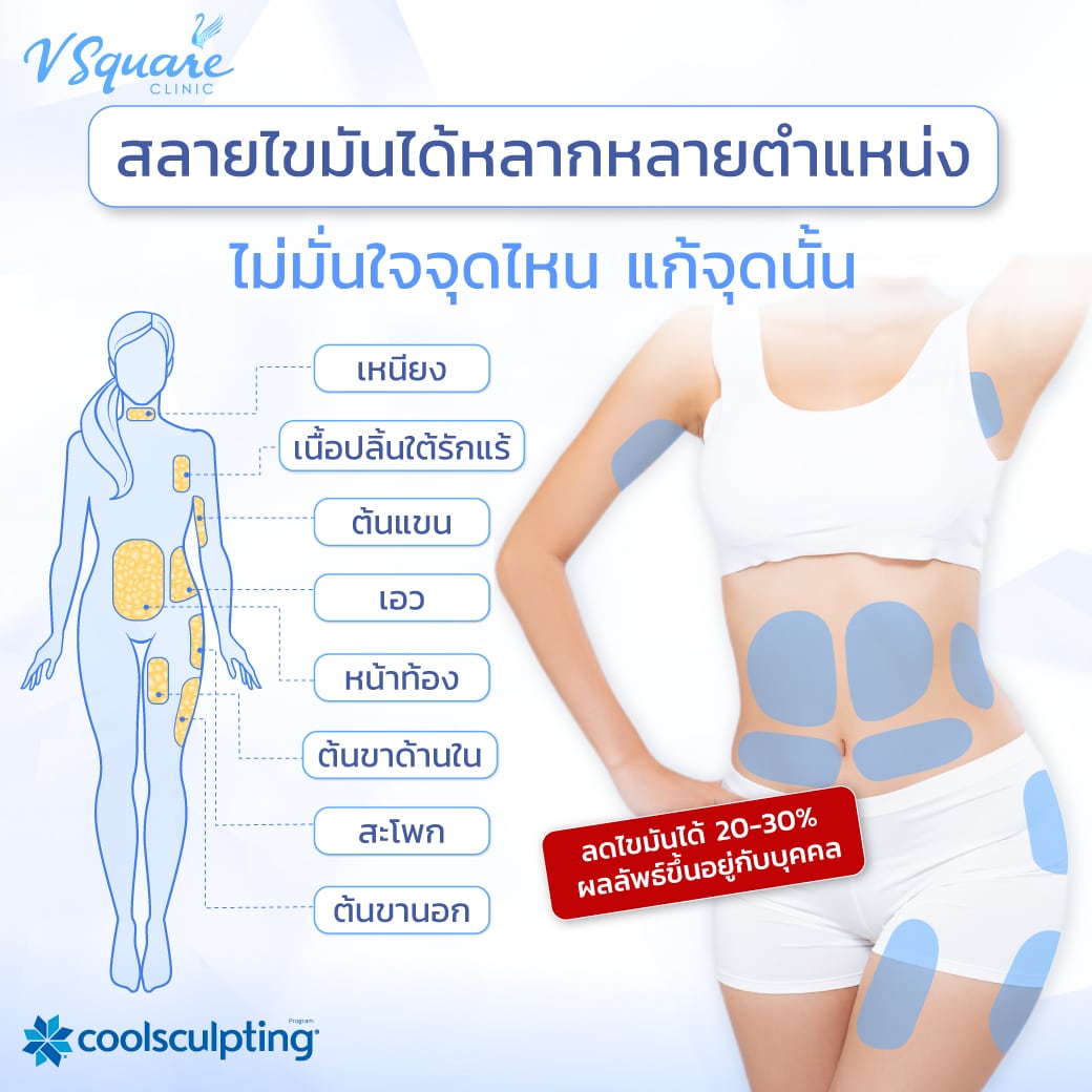CoolSculpting ทำส่วนไหนได้บ้าง