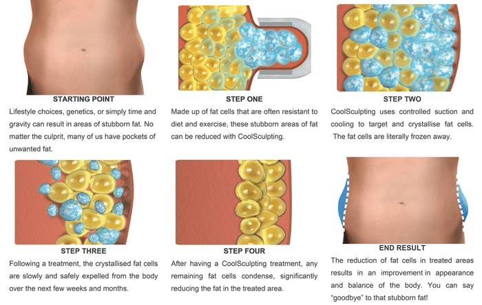 กระบวนการทำงานของ Coolsculpting