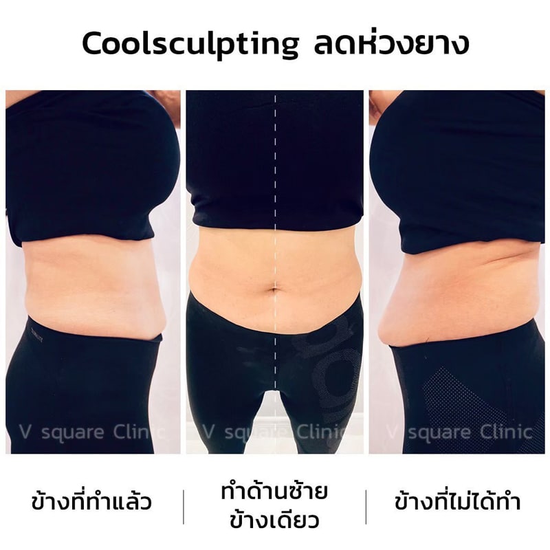 รีวิว Coolsculpting จำกัดเซลล์ไขมันหน้าท้อง ห่วงยาง
