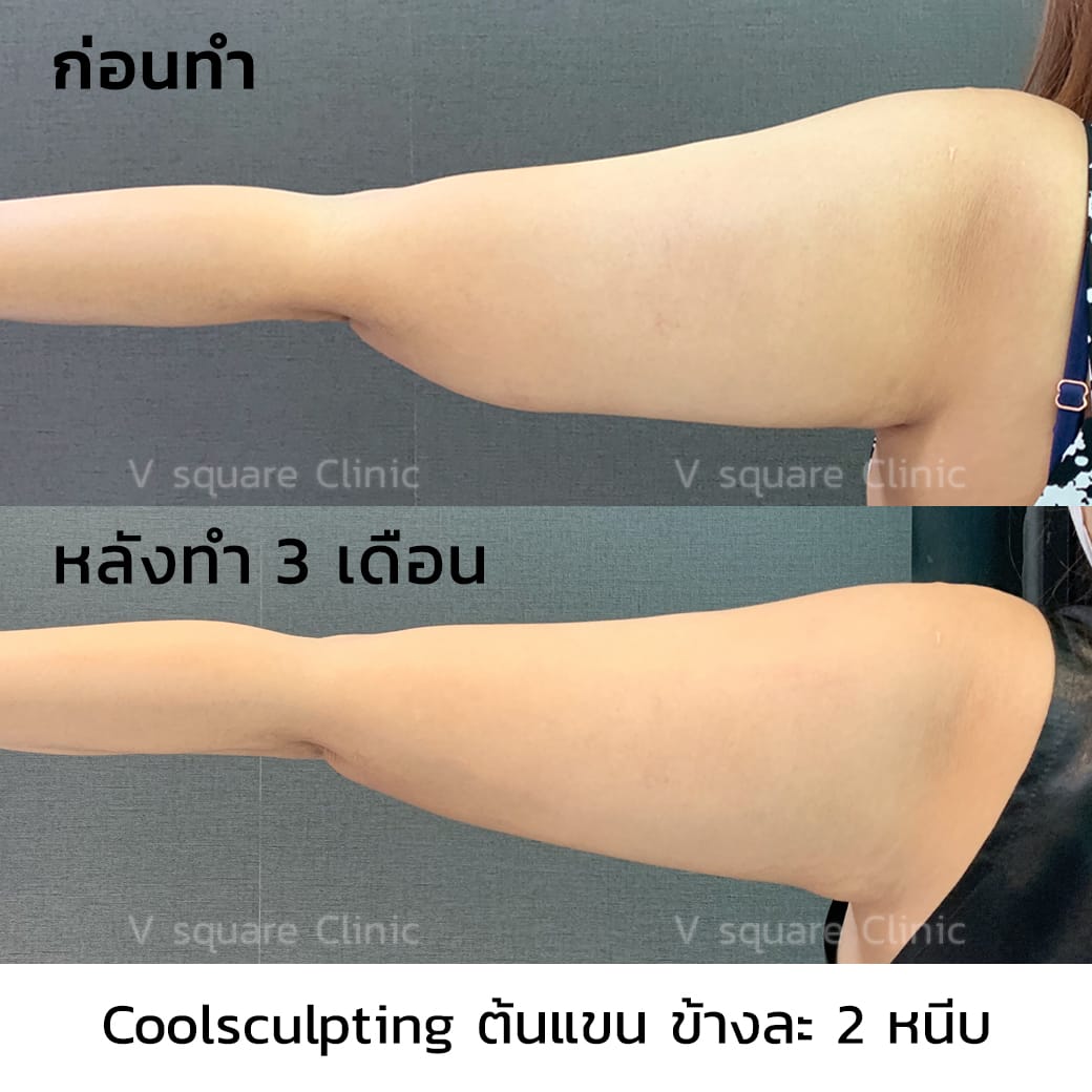รีวิว Coolsculpting จำกัดเซลล์ไขมันใต้แขน
