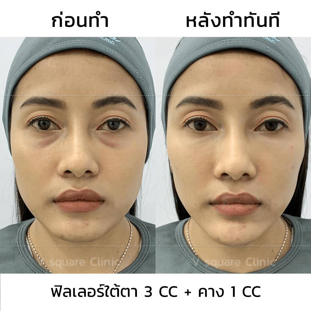 รีวิวฟิลเลอร์ใต้ตา