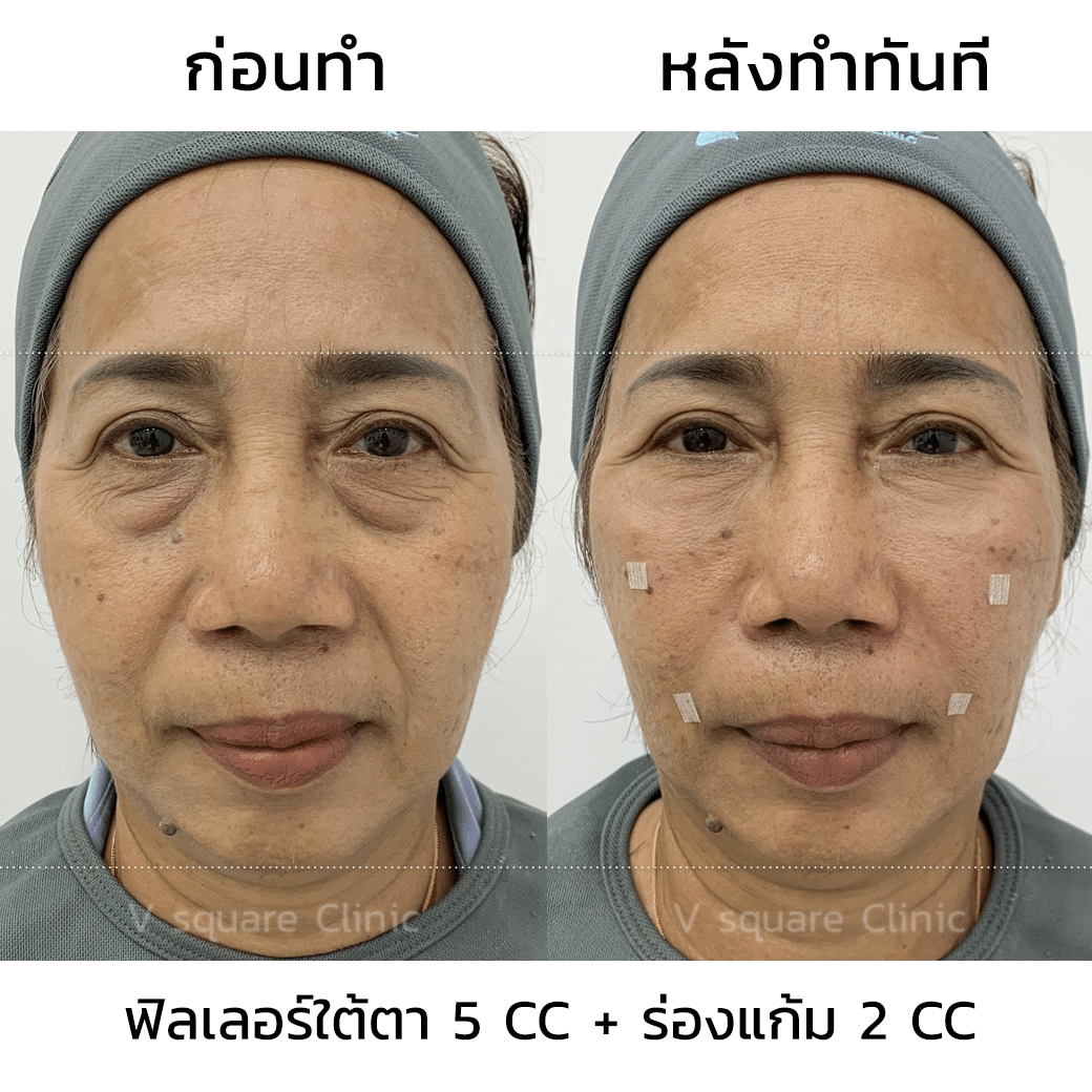 รีวิวฟิลเลอร์ใต้ตา