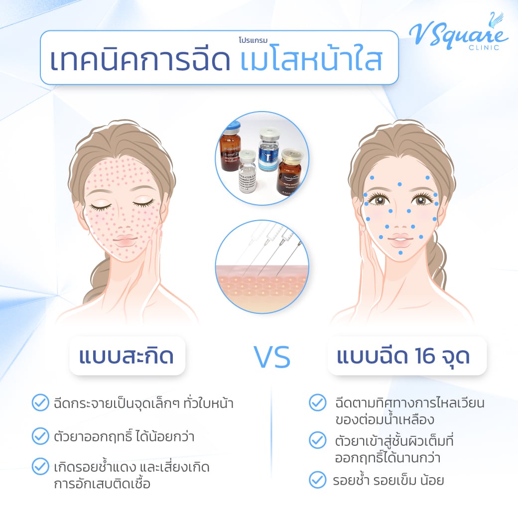 เมโสหน้าใสแบบสะกิด vs แบบ 16 จุด