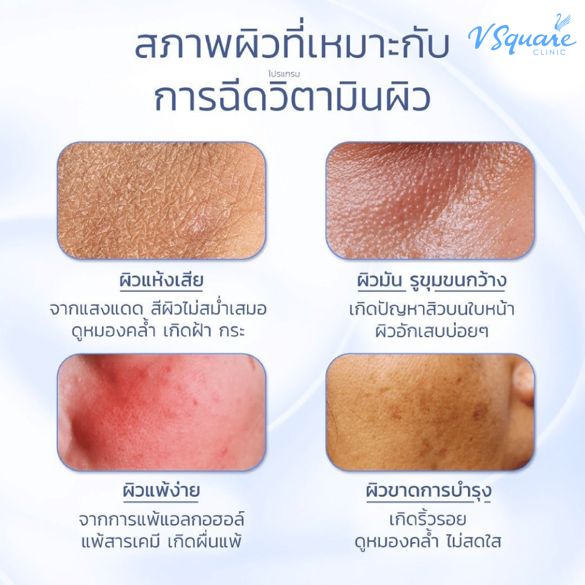 สภาพผิวฉีดวิตามินผิว