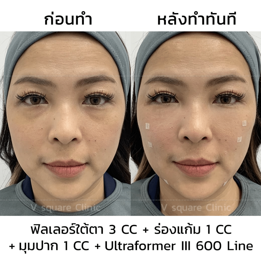 รีวิว Ultraformer III