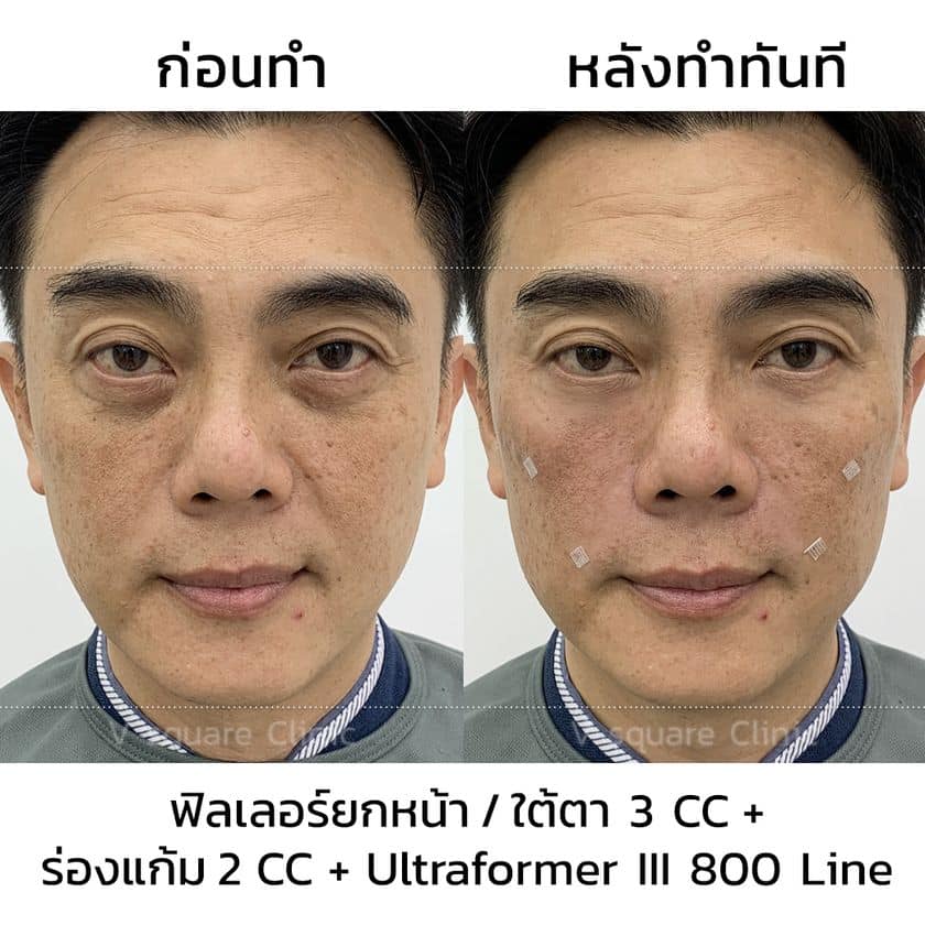 รีวิว Ultraformer III