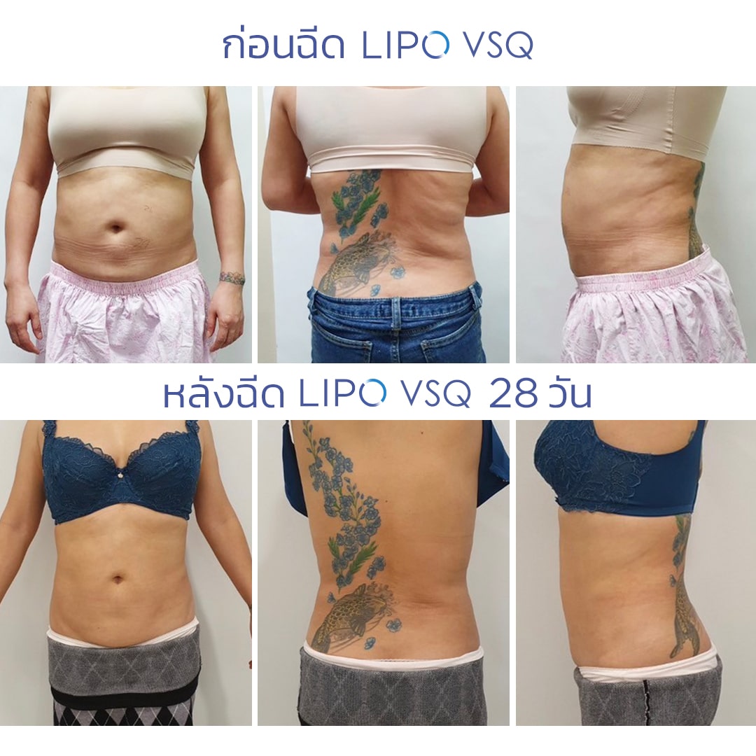 เมโสแฟต Lipo Vsq รีวิว