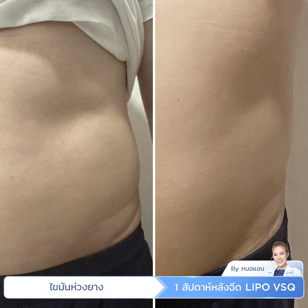 เมโสแฟต  Lipo Vsq รีวิว