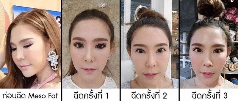 เมโสแฟต รีวิว