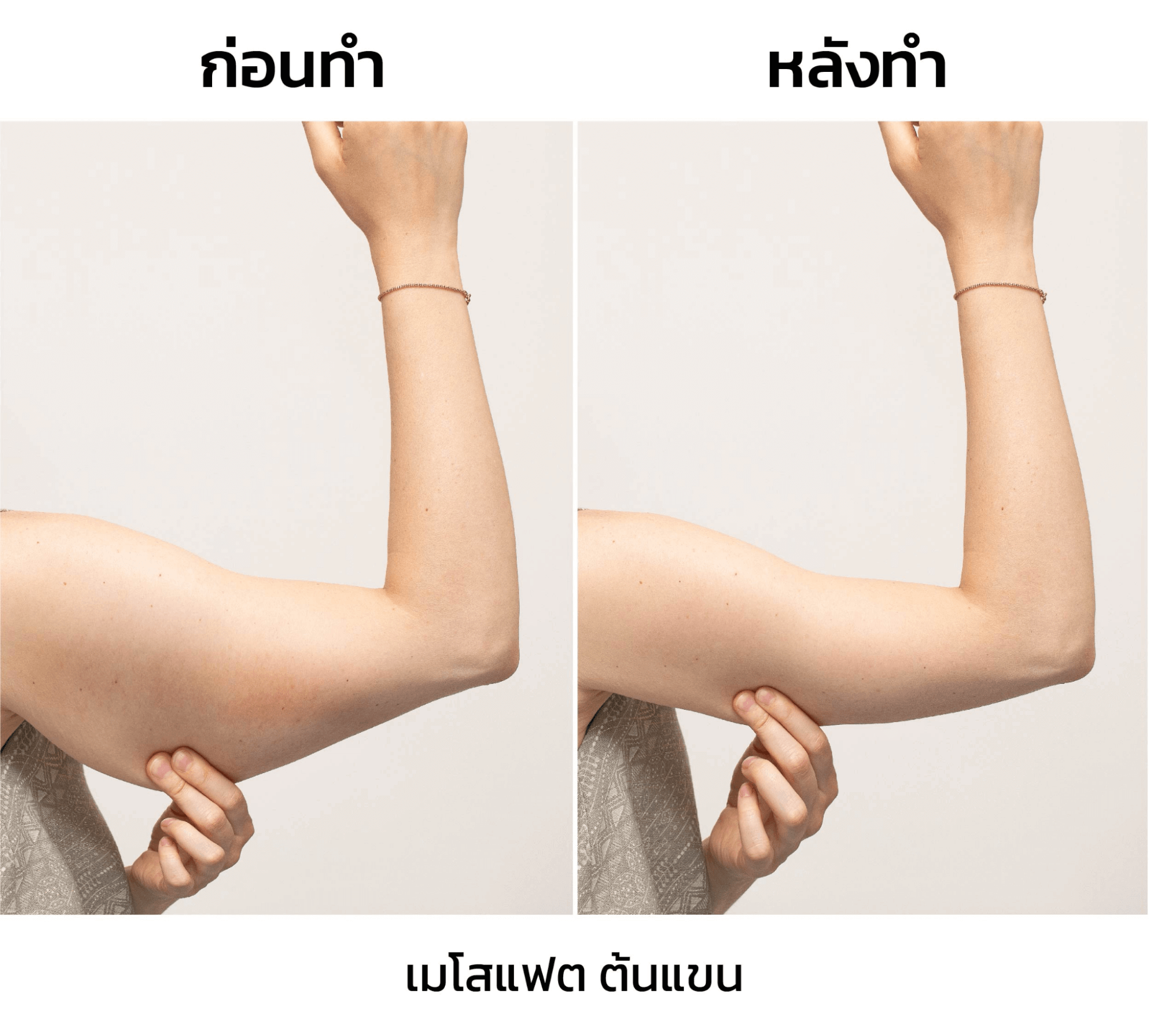 เมโสแฟต รีวิว