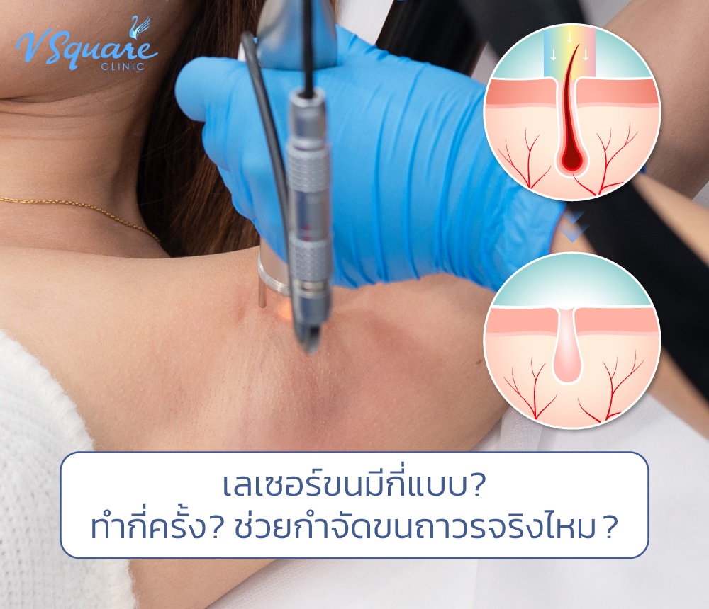 เลเซอร์ขน