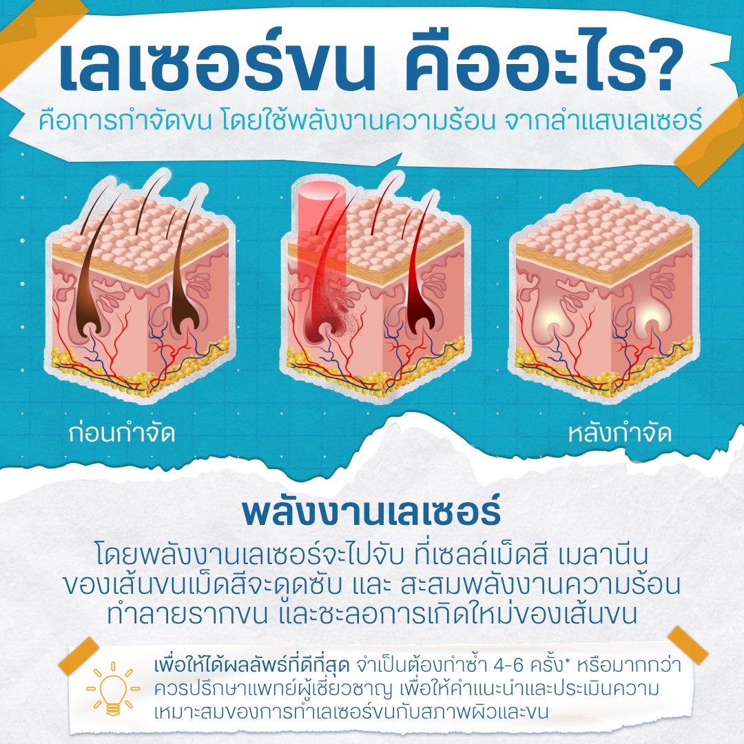 การทำงานของเลเซอร์กำจัดขน