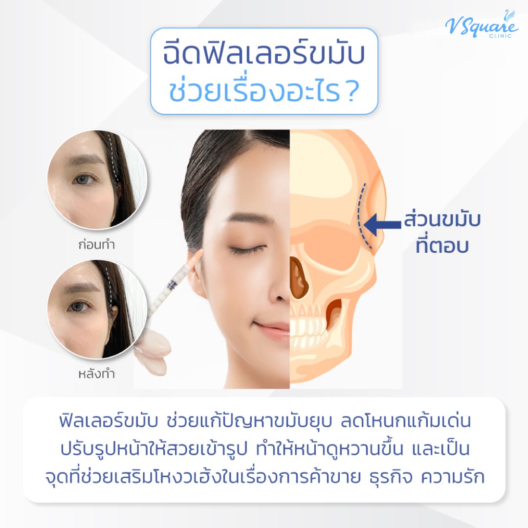 ฟิลเลอร์ขมับ ช่วยเรื่องอะไรบ้าง